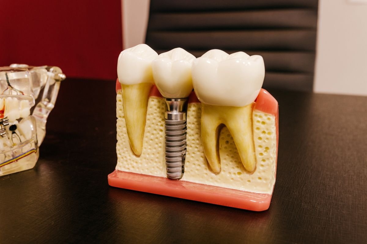 Modelo dental con un implante de titanio y su corona.
