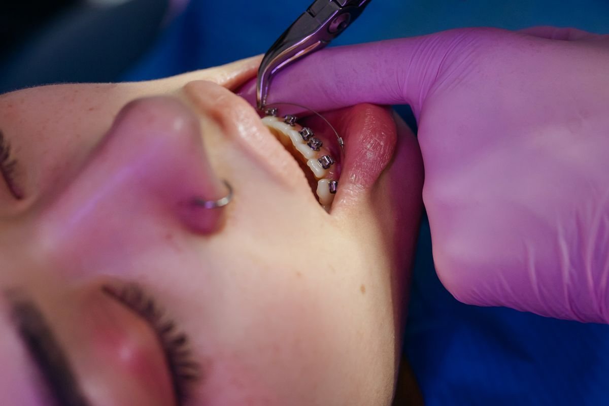 Ortodoncista ajustando brackets a un paciente en Puebla.