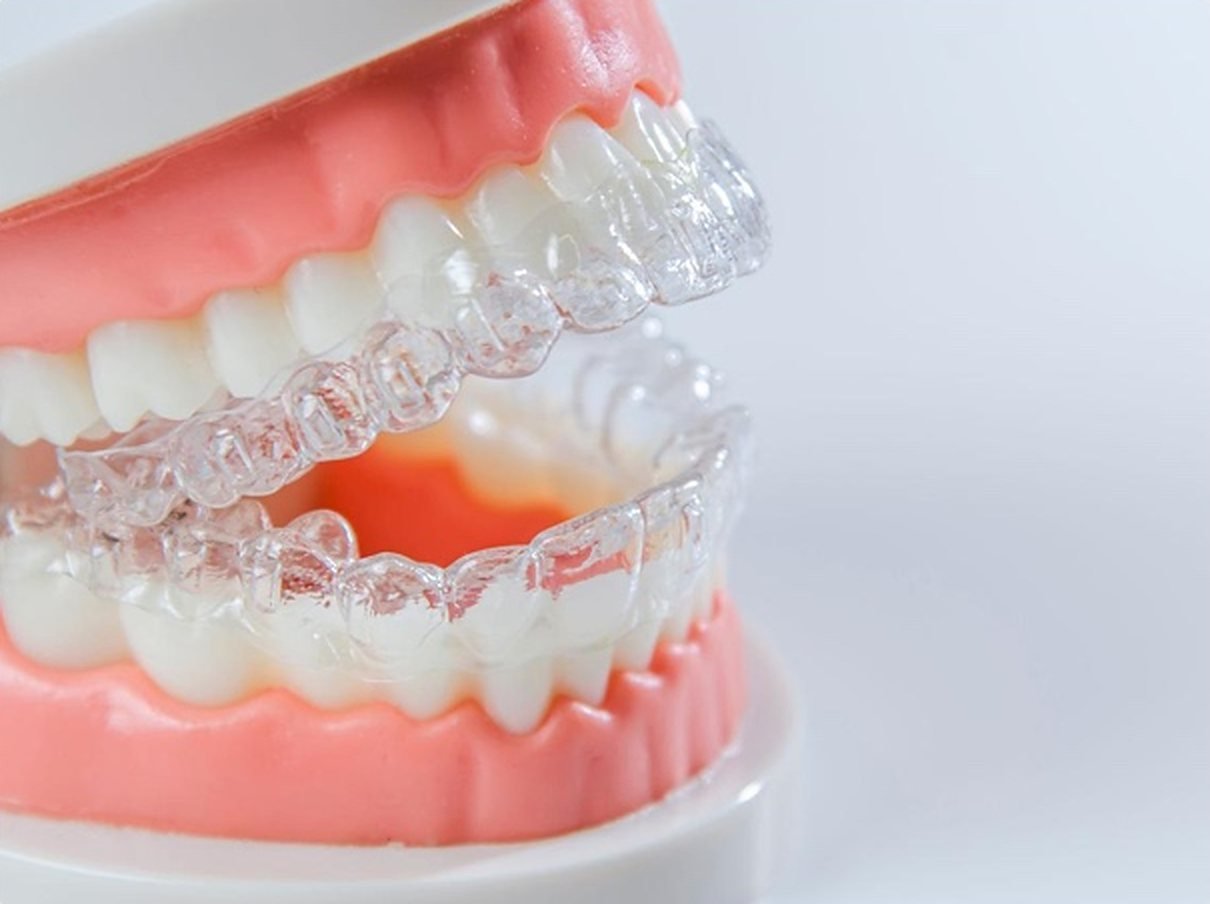 Alineadores transparentes sobre un modelo dental.