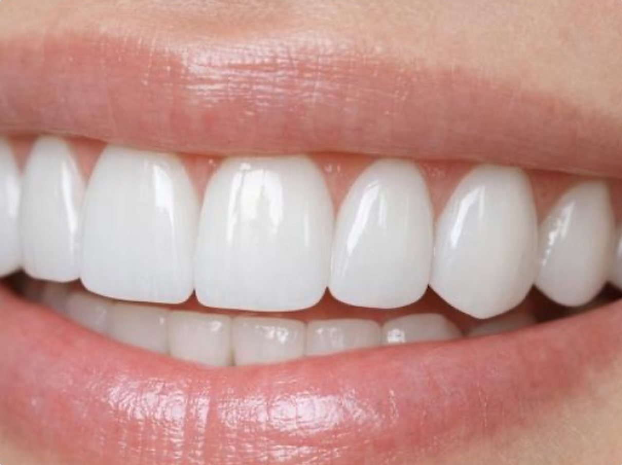 Sonrisa con carillas dentales blancas y naturales.