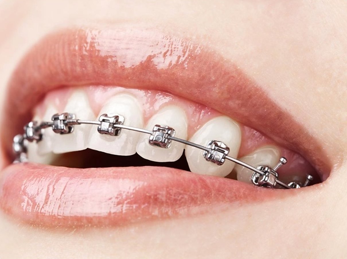 Sonrisa con brackets metálicos.